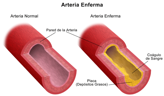 Arteria normal y arteria obstruida
