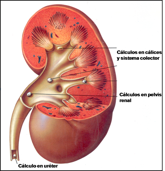 Calculo renal