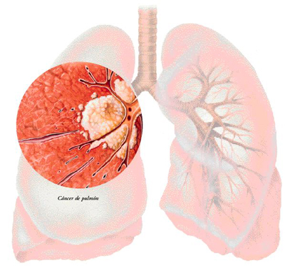 Cancer de pulmon