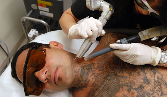 Eliminacion de tatuajes
