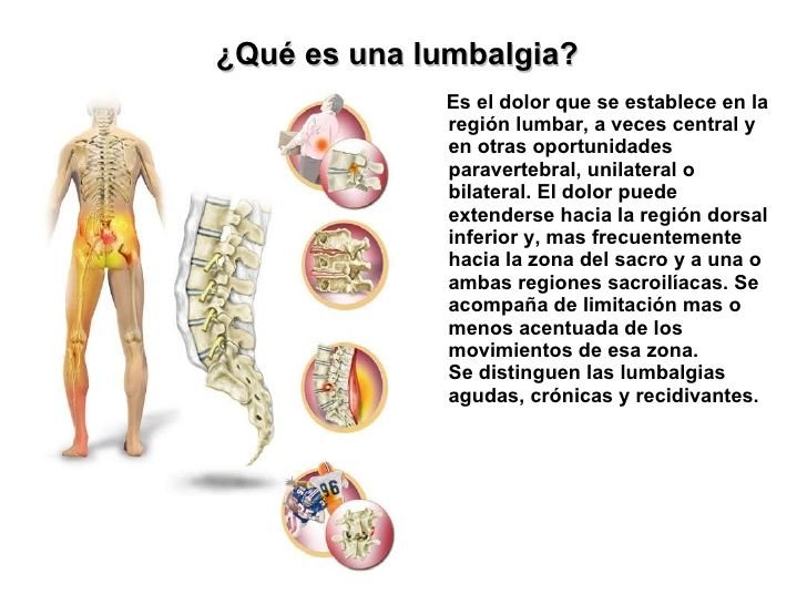 Lumbalgia