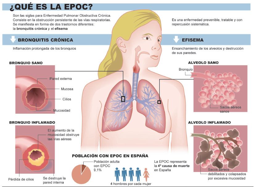 bronquios alveolos EPOC